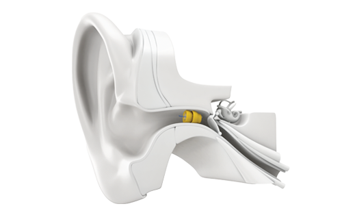 Invisible in the ear